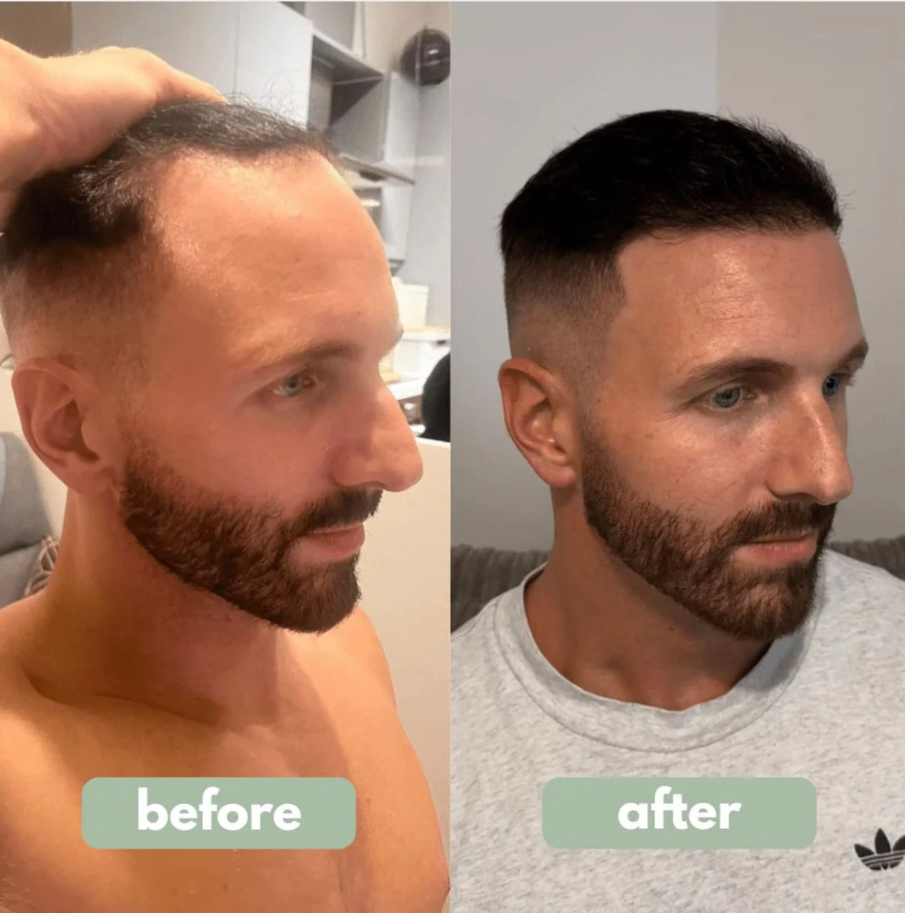 Reverse™ - Hair Growth Serum